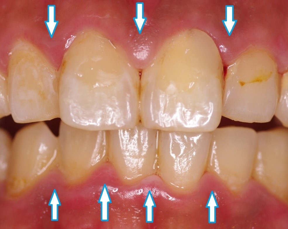 初期の歯周病(歯肉炎)に伴う歯肉の腫れと出血の改善