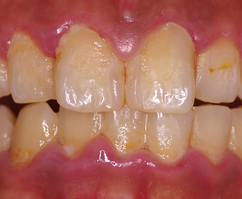初期の歯周病(歯肉炎)に伴う歯肉の腫れと出血の改善