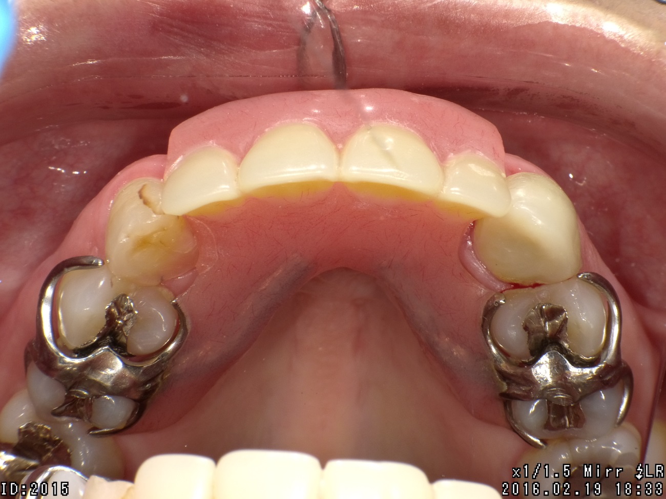 中等度歯周炎治療の症例