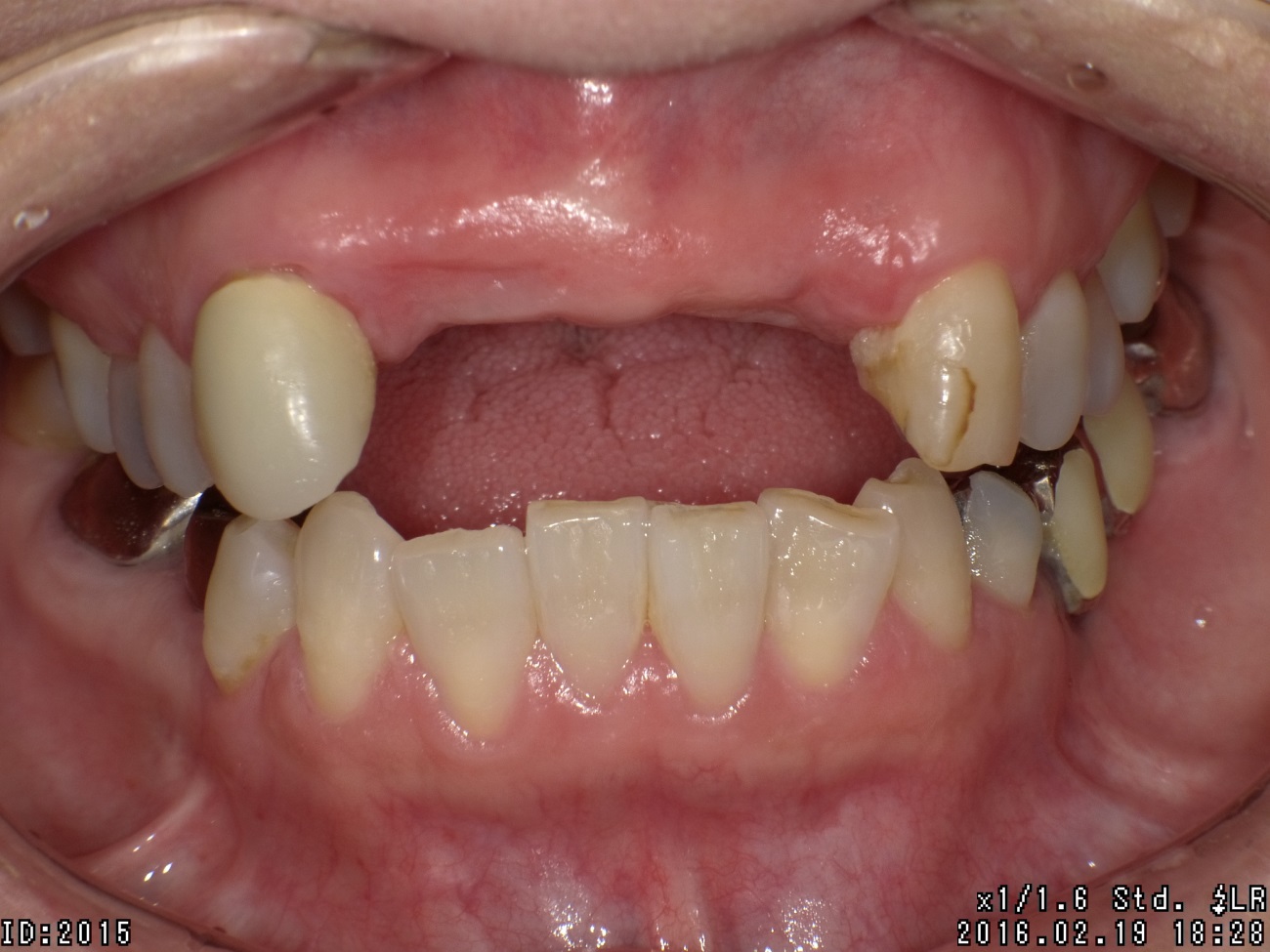 中等度歯周炎治療の症例