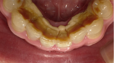 50代男性 熱いものを食べると左側の奥歯が痛む 歯の神経の治療および歯石除去の症例 武蔵中原駅徒歩5分 中林デンタルケアークリニック