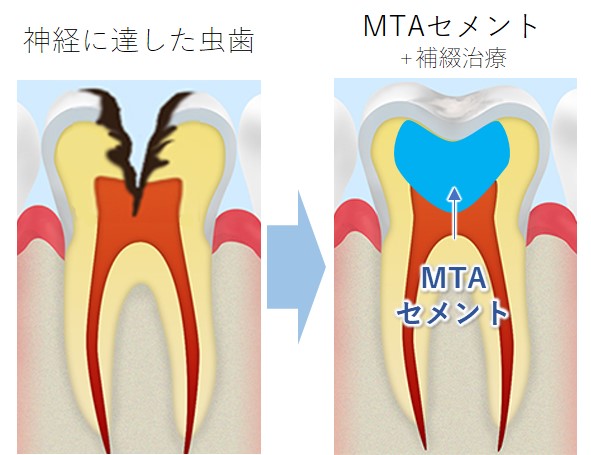 武蔵中原の歯医者、中林デンタルケアークリニックのMTAセメント