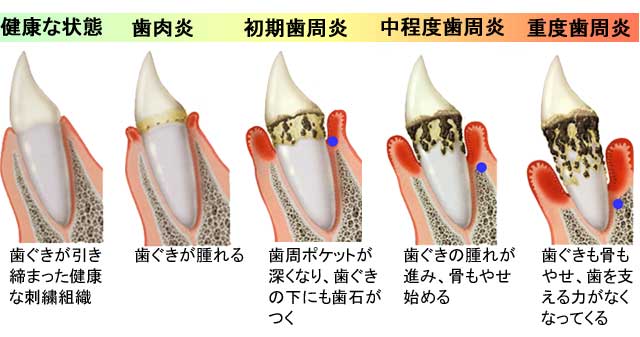 武蔵中原の歯医者、中林デンタルケアークリニックで25歳からの虫歯予防