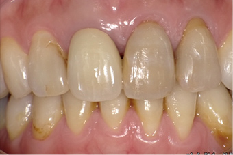 差し歯の変色改善