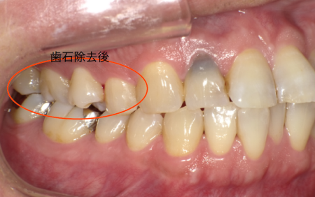 武蔵中原の歯医者、中林デンタルケアークリニの治療症例、治療後