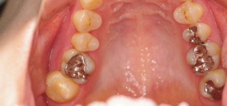 武蔵中原の歯医者、中林デンタルケアークリニの治療症例、治療後