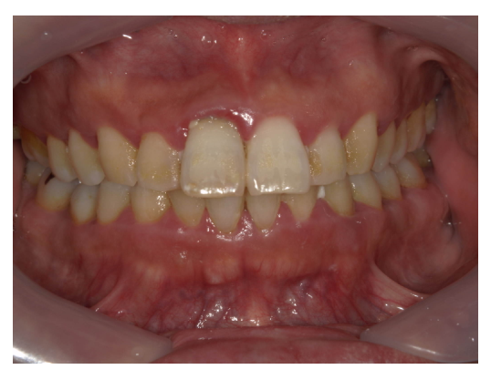 武蔵中原の歯医者、中林デンタルケアークリニックのSRP症例、治療前