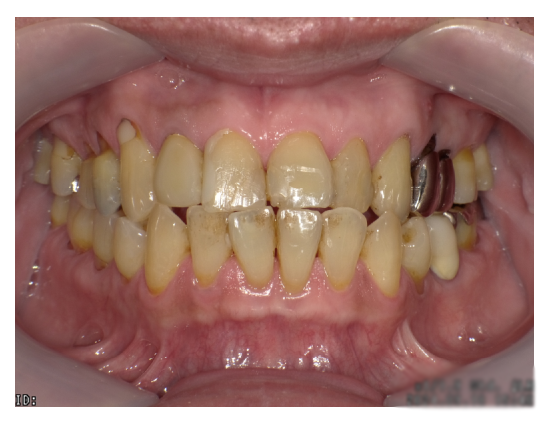 武蔵中原の歯医者、中林デンタルケアークリニックのクリーニング症例、治療前
