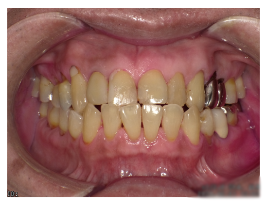 武蔵中原の歯医者、中林デンタルケアークリニックのクリーニング症例、治療前