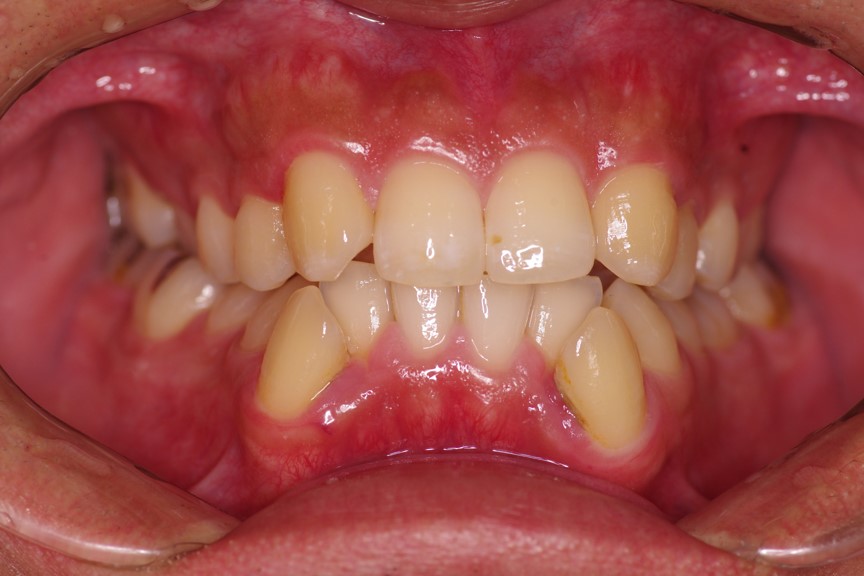 武蔵中原の歯医者、中林デンタルケアークリニックのクリーニング症例、治療前