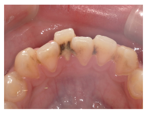 武蔵中原の歯医者、中林デンタルケアークリニックのクリーニング症例、治療前