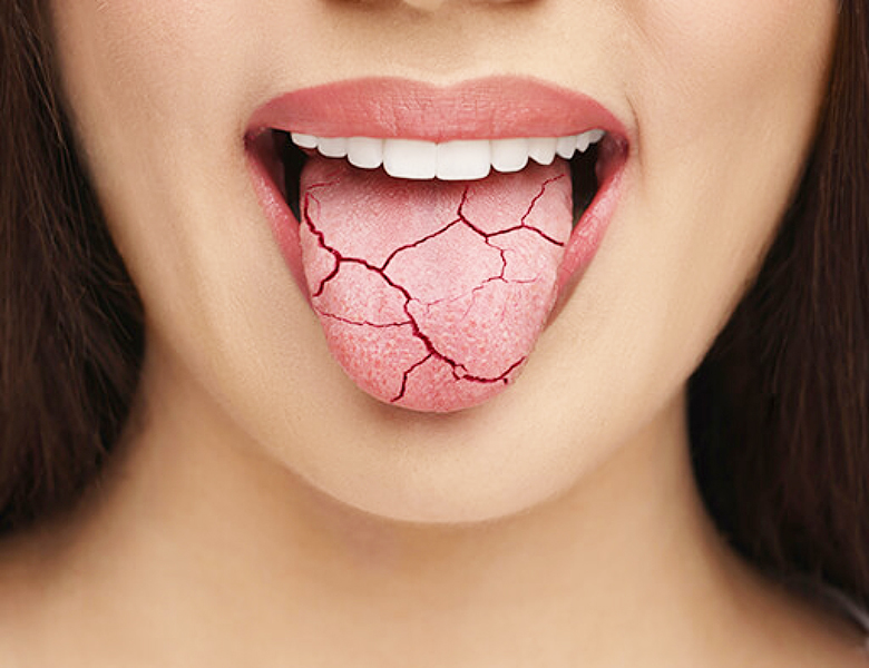 武蔵中原の歯医者、中林デンタルケアークリニックでドライマウスを招く生活習慣と対策を解説