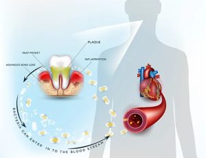 武蔵中原の歯医者、中林デンタルケアークリニックで周術期等口腔機能管理についての解説