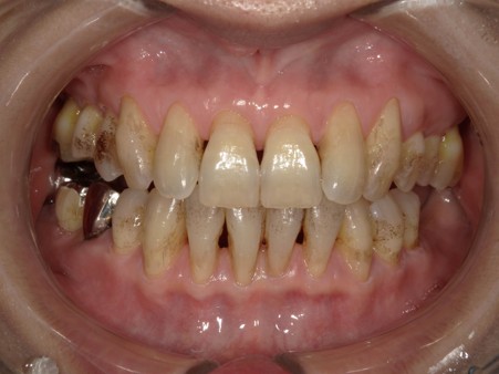 武蔵中原の歯医者、中林デンタルケアークリニックのステイン除去とオフィスホワイトニング症例、治療前