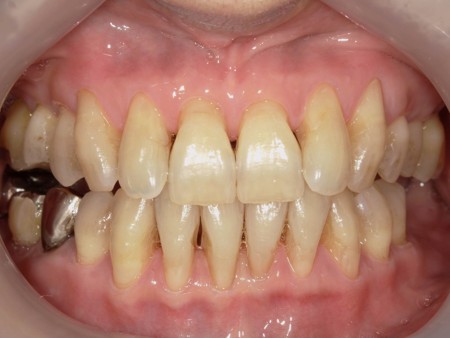 武蔵中原の歯医者、中林デンタルケアークリニックのステイン除去とオフィスホワイトニング症例、治療後