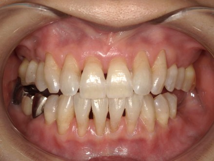 武蔵中原の歯医者、中林デンタルケアークリニックのステイン除去とオフィスホワイトニング症例、治療後