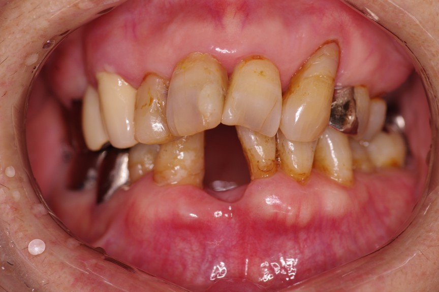 武蔵中原の歯医者、中林デンタルケアークリニックの接着性ブリッジ、治療前