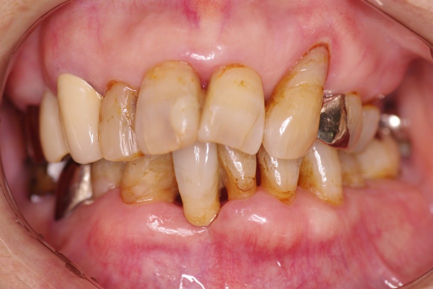 武蔵中原の歯医者、中林デンタルケアークリニックの接着性ブリッジ、治療後