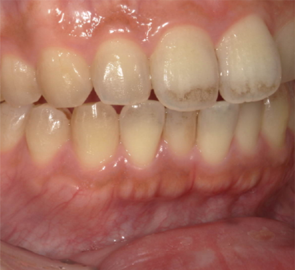 武蔵中原の歯医者、中林デンタルケアークリニックのステイン除去とオフィスホワイトニング症例、治療前