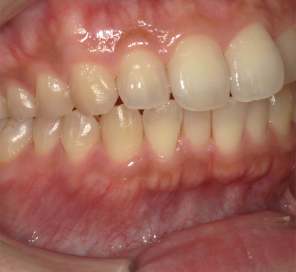 武蔵中原の歯医者、中林デンタルケアークリニックの着色除去症例、治療後
