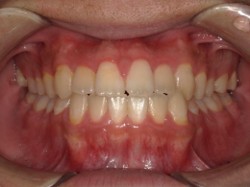 武蔵中原の歯医者、中林デンタルケアークリニックの予防症例、治療前