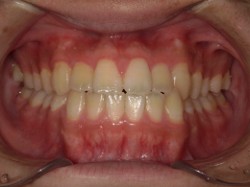 武蔵中原の歯医者、中林デンタルケアークリニックの予防症例、治療後