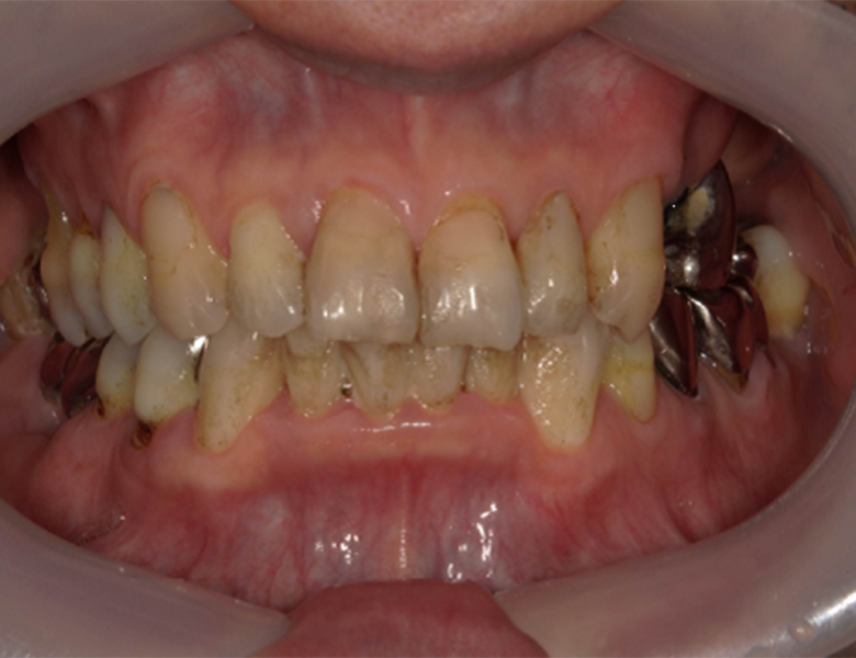 武蔵中原の歯医者、中林デンタルケアークリニックの予防症例、治療前