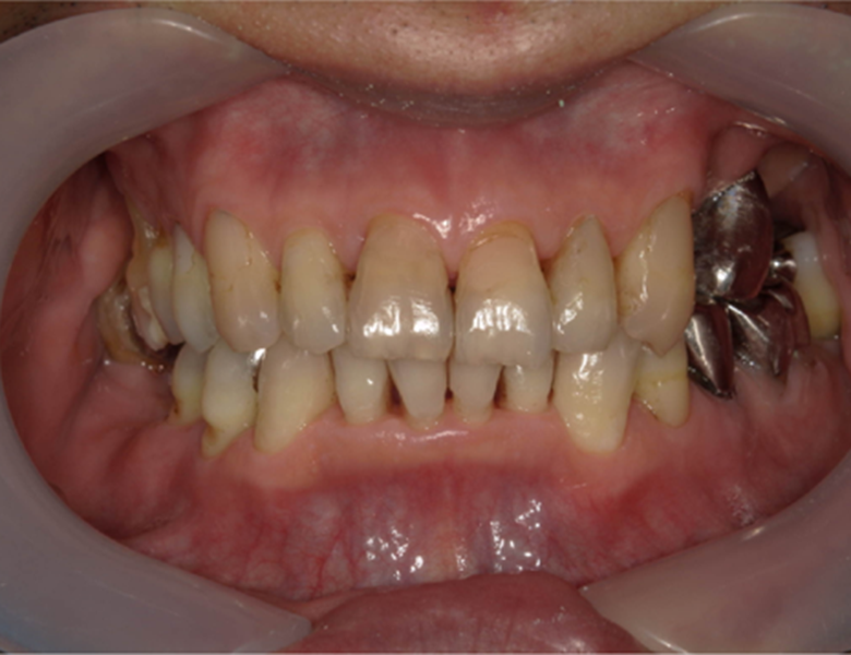 武蔵中原の歯医者、中林デンタルケアークリニックの予防症例、治療後