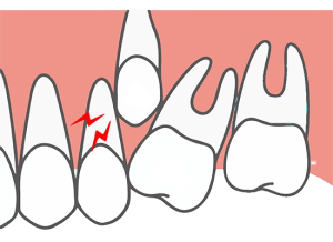 武蔵中原の歯医者、中林デンタルケアークリニックで子どもの乳歯が抜けない・永久歯が生えない場合の原因や対処法を解説