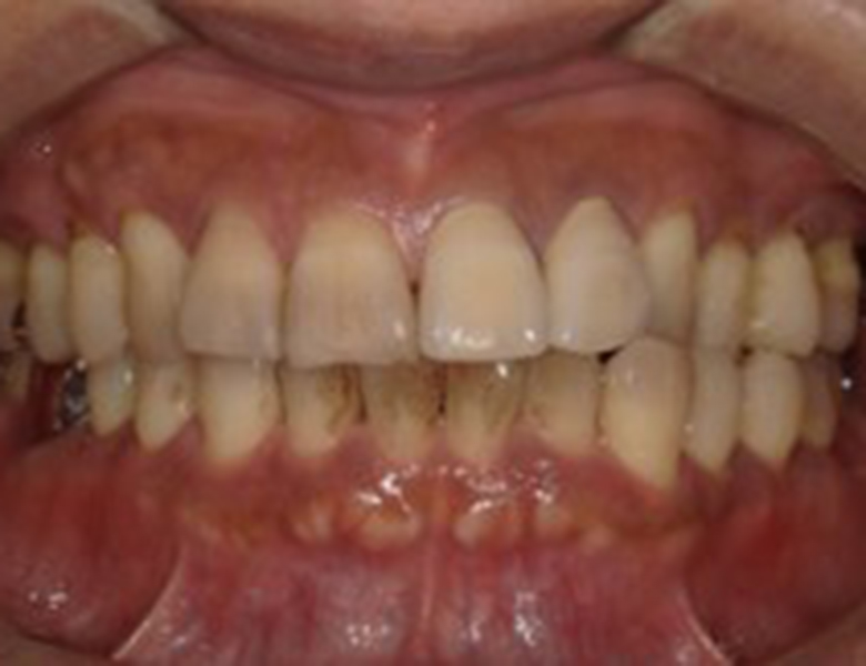 武蔵中原の歯医者、中林デンタルケアークリニックの予防症例、治療前