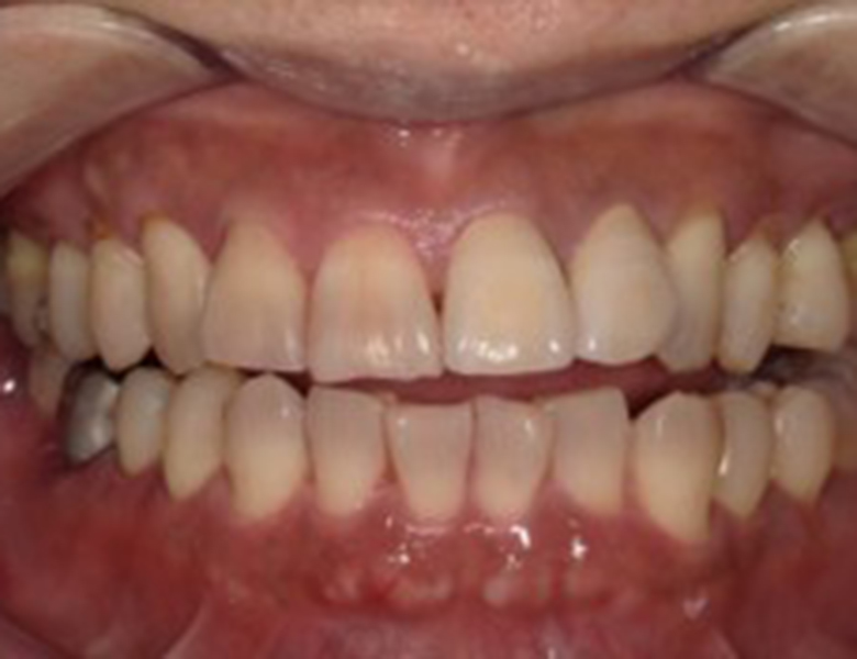 武蔵中原の歯医者、中林デンタルケアークリニックの予防症例、治療後