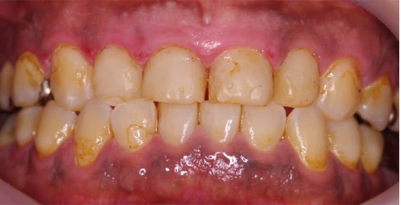 武蔵中原の歯医者、中林デンタルケアークリニックの予防症例、治療前