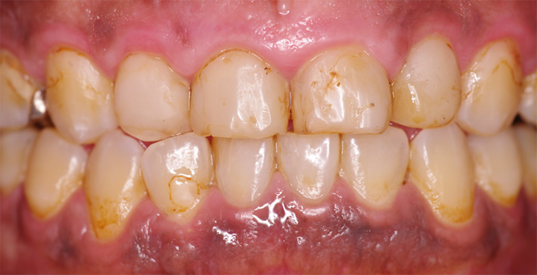 武蔵中原の歯医者、中林デンタルケアークリニックの予防症例、治療後