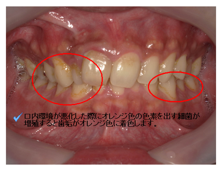 武蔵中原の歯医者、中林デンタルケアークリニックの予防症例、治療前