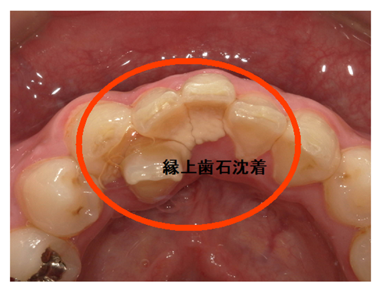 武蔵中原の歯医者、中林デンタルケアークリニックの予防症例、治療後