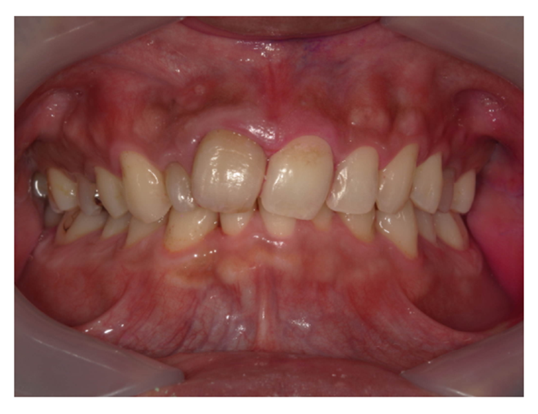 武蔵中原の歯医者、中林デンタルケアークリニックの予防症例、治療後