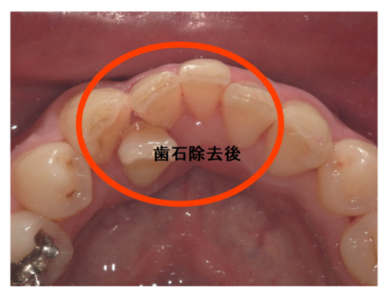 武蔵中原の歯医者、中林デンタルケアークリニックの予防症例、治療後