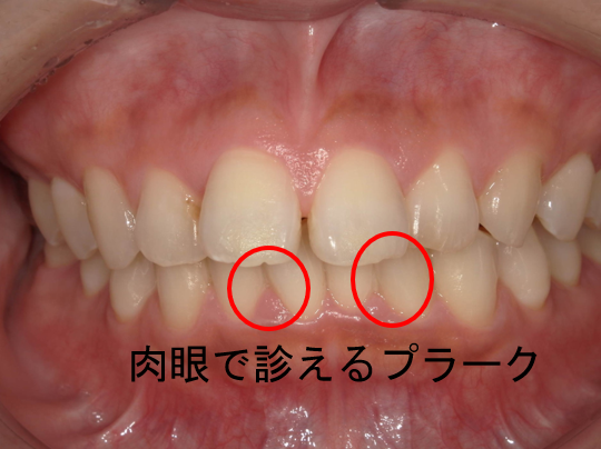 武蔵中原の歯医者、中林デンタルケアークリニックの予防症例、治療前