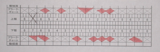 武蔵中原の歯医者、中林デンタルケアークリニックの予防症例、治療前