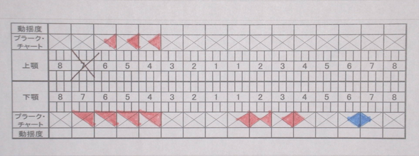 武蔵中原の歯医者、中林デンタルケアークリニックの予防症例、治療前