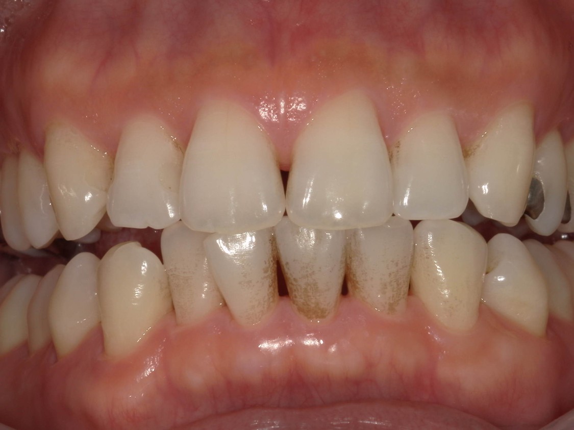 武蔵中原の歯医者、中林デンタルケアークリニックの予防症例、治療前