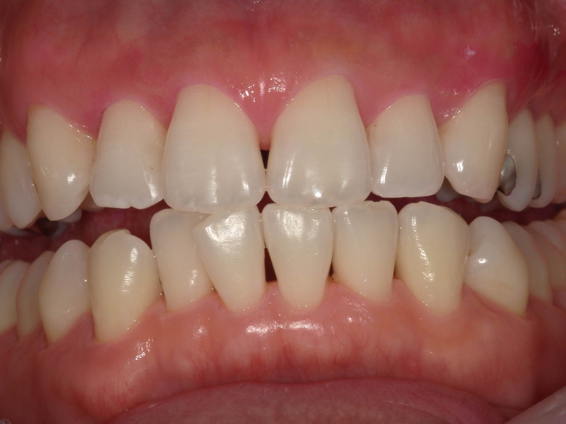 武蔵中原の歯医者、中林デンタルケアークリニックの予防症例、治療前