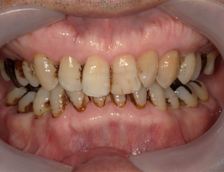 武蔵中原の歯医者、中林デンタルケアークリニックの予防症例、治療前