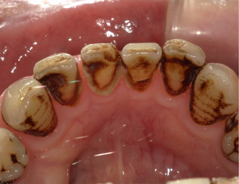 武蔵中原の歯医者、中林デンタルケアークリニックの予防症例、治療前