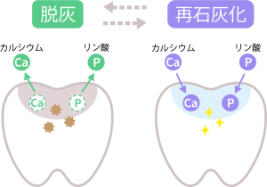 武蔵中原の歯医者、中林デンタルケアークリニックで初期虫歯を削らずに治療する「再石灰化」促進の方法を解説