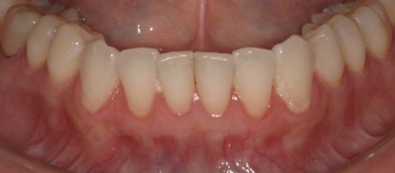 武蔵中原の歯医者、中林デンタルケアークリニックの予防症例、治療前