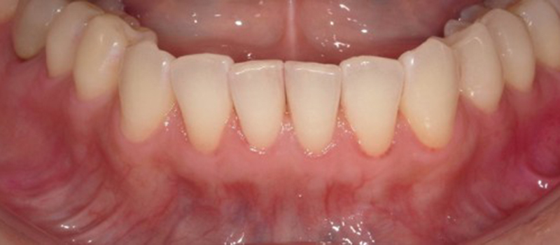 武蔵中原の歯医者、中林デンタルケアークリニックの予防症例、治療前