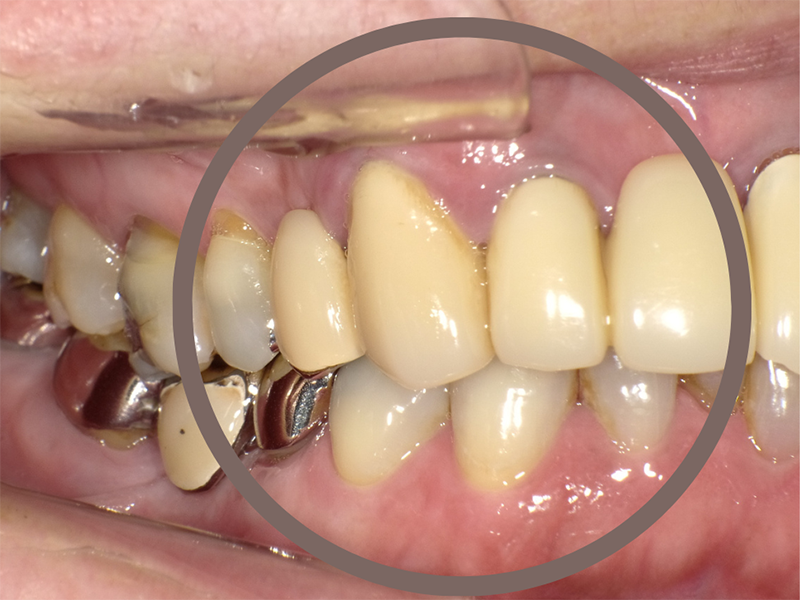 武蔵中原の歯医者、中林デンタルケアークリニックの予防症例、治療前