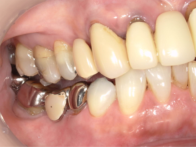 武蔵中原の歯医者、中林デンタルケアークリニックの予防症例、治療前